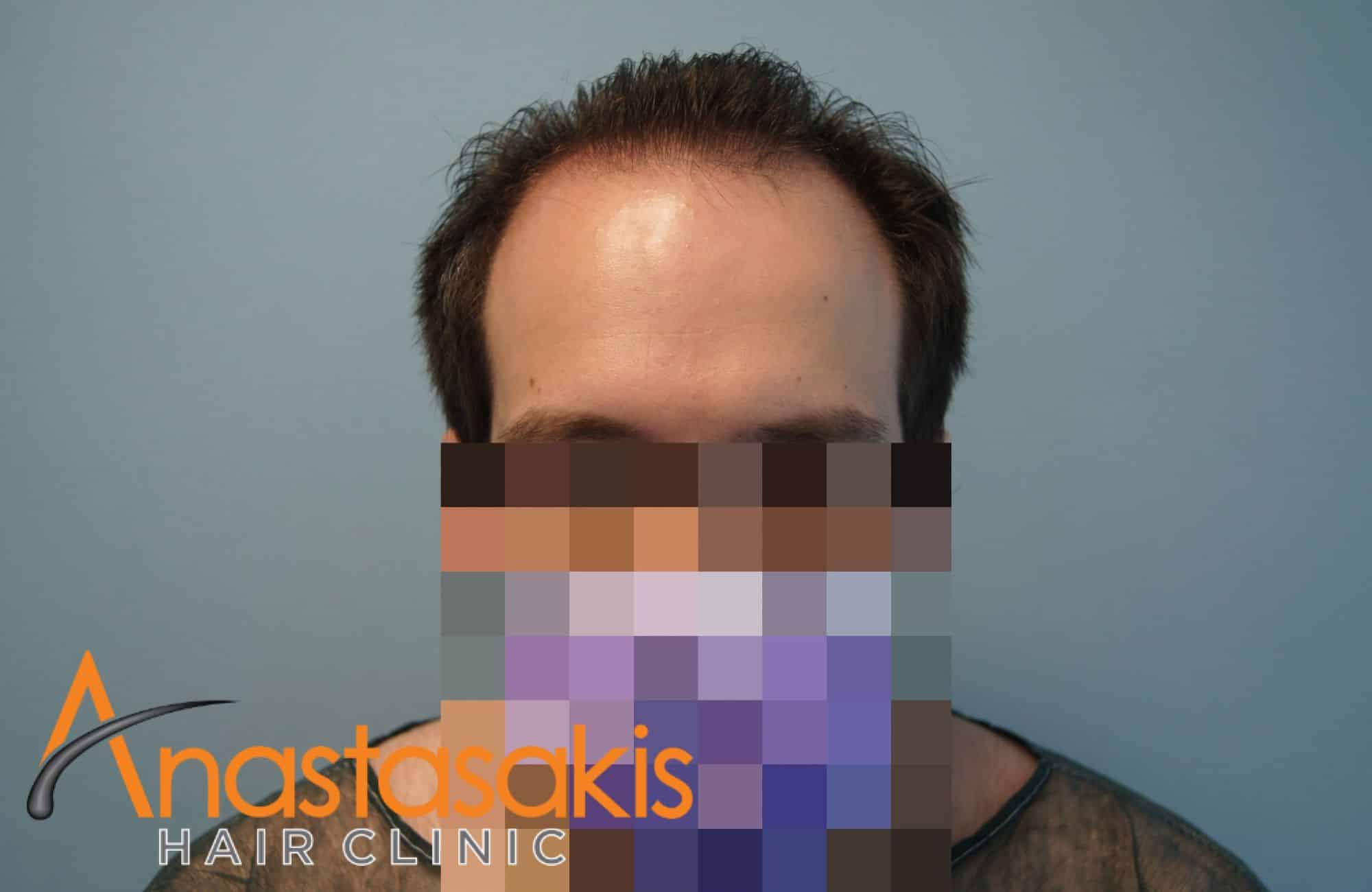 asthenis prin ti mm 2500fus fullface