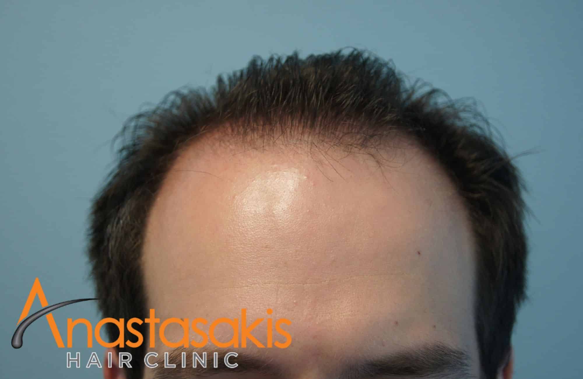 asthenis prin ti mm 2500fus hairline