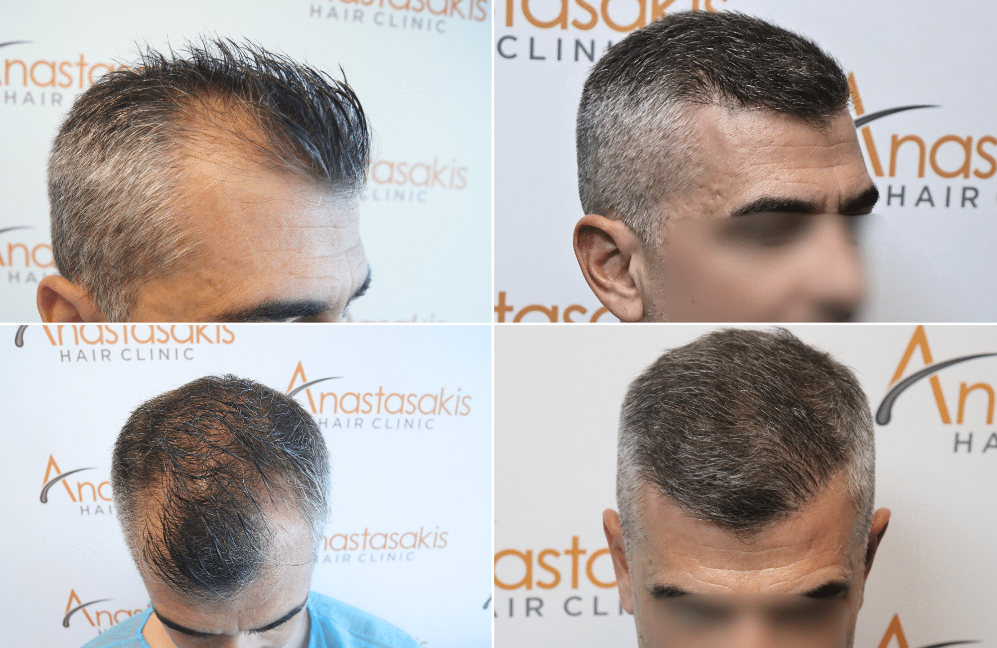 https://www.anastasakishairclinic.gr/portfolio/apotelesma-7-mines-met-ti-metamosxefsi-mallion-2500fus/