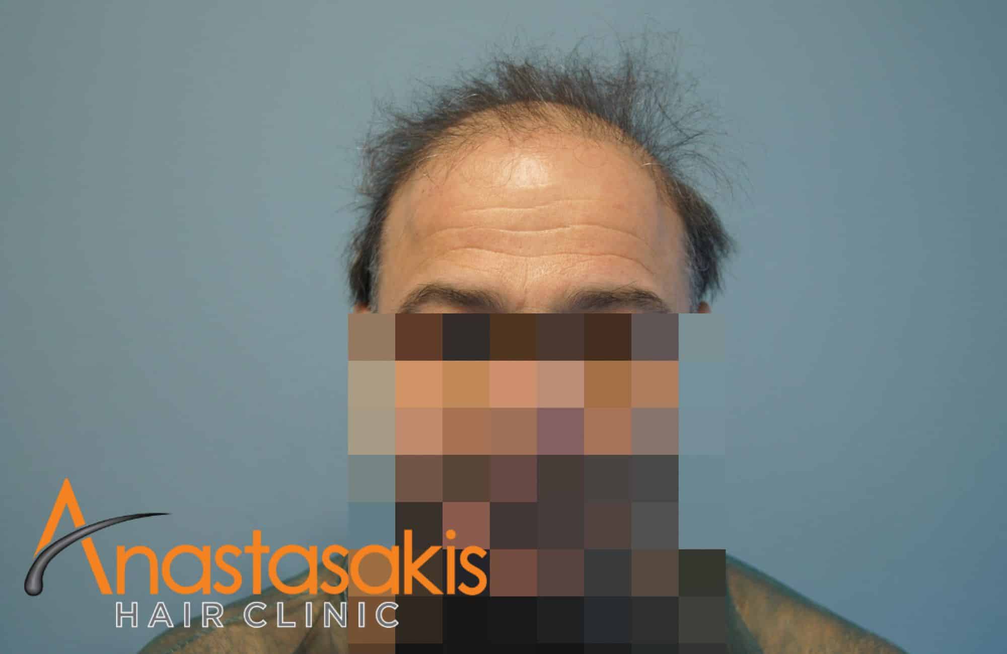 peristatiko me 3082 fus- texniki fut ahc fullface before
