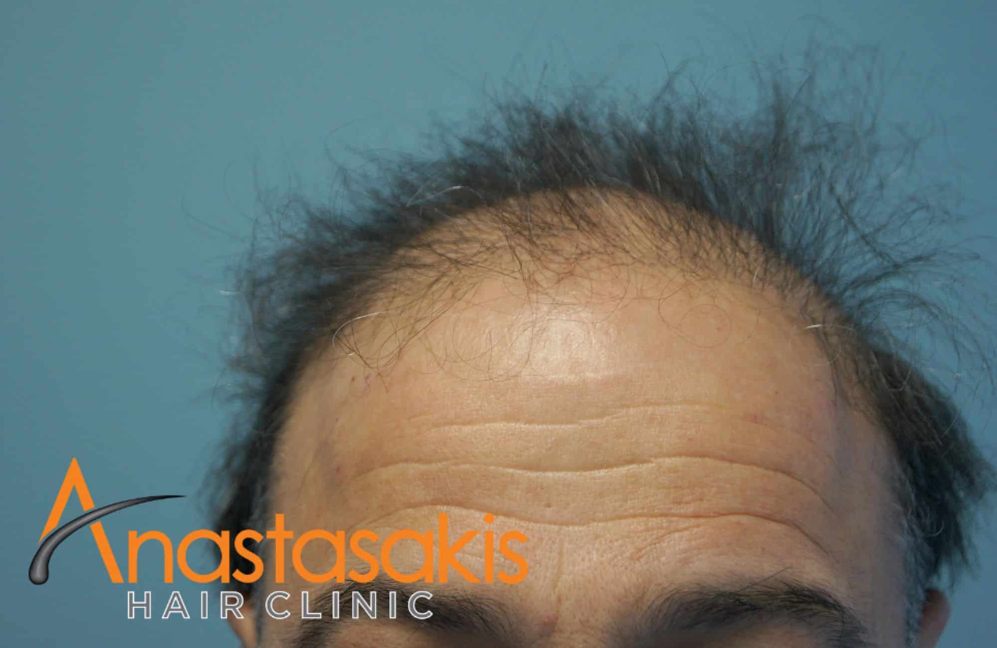 peristatiko me 3082 fus- texniki fut ahc hairline before