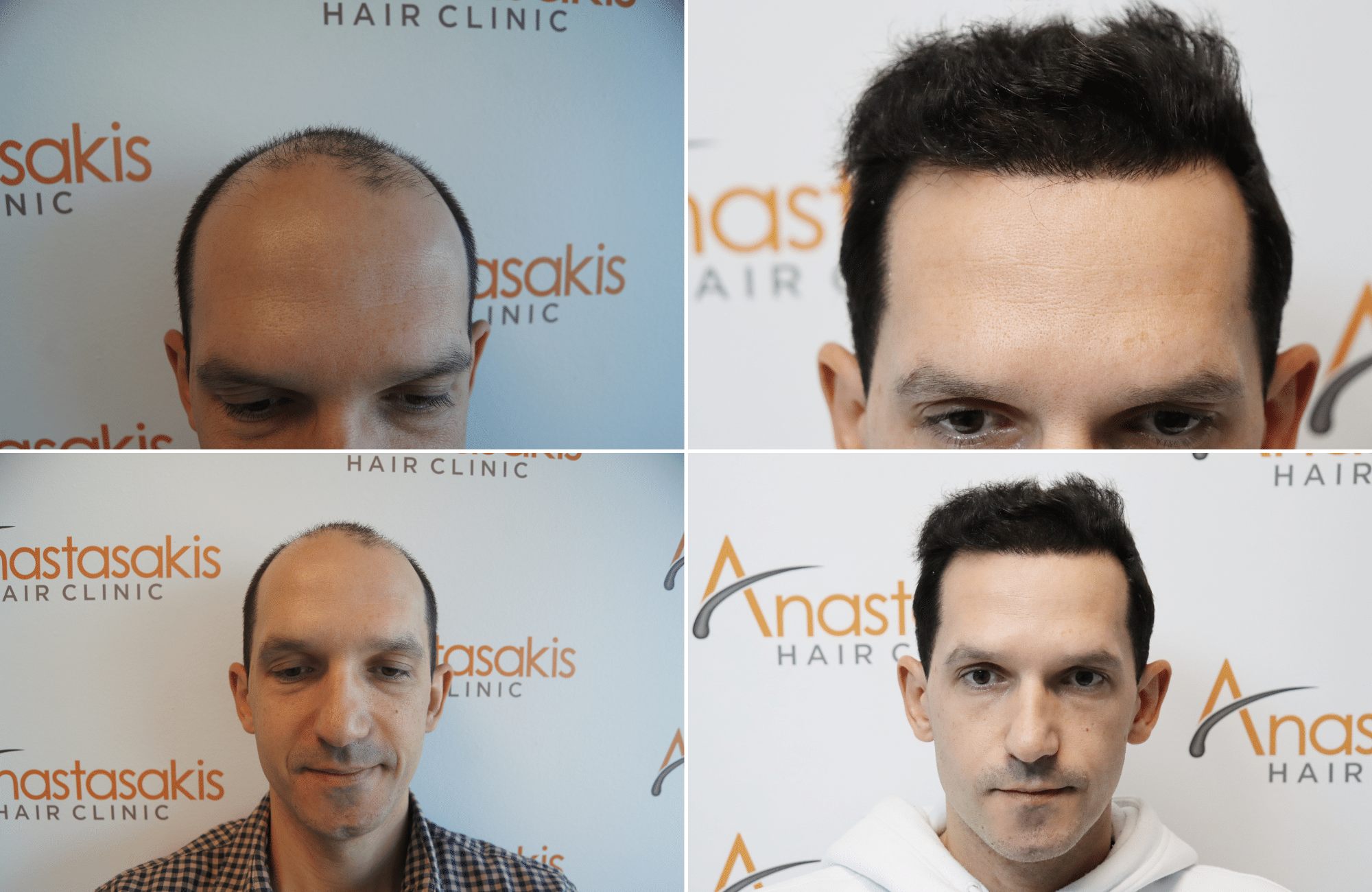 https://www.anastasakishairclinic.gr/portfolio/apotelesma-metamosxefsis-mallion-anastasakis-hair-clinic-43/