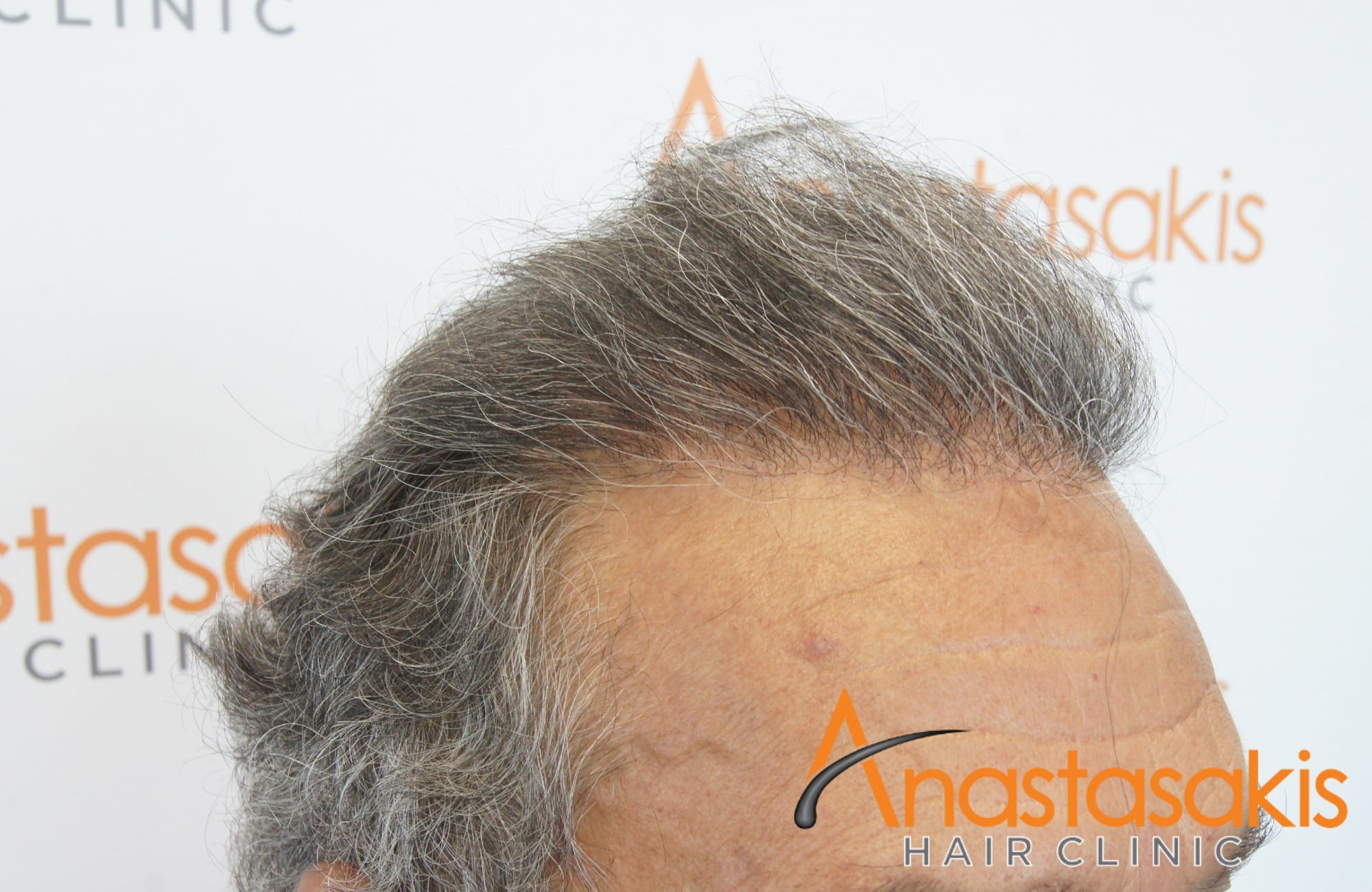 αποτελεσμα μεταμοσχευσης μαλλιων με 3964 fus - δεξης κροταφος