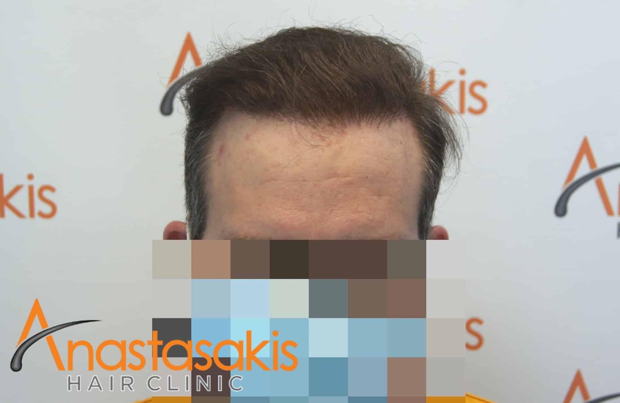 περιστατικο με 3500 fus - αποτελεσμα ετους - fullface