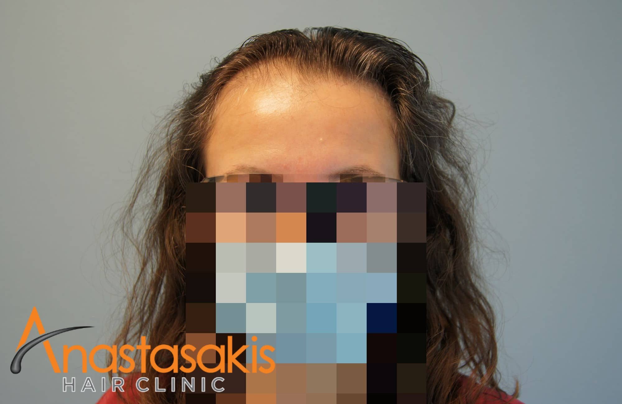περιστατικό με 2600 fus - πριν τη μεταμόσχευση μαλλιών - γυναίκα - fullface