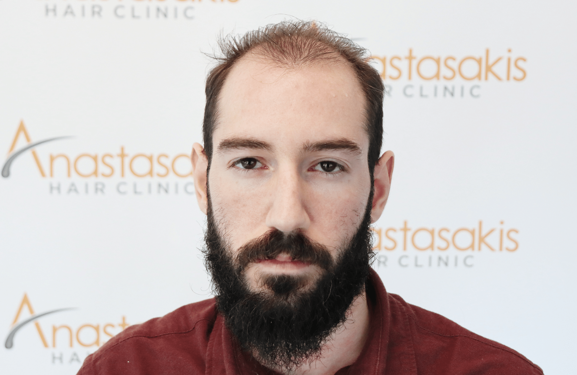 hair transplant result