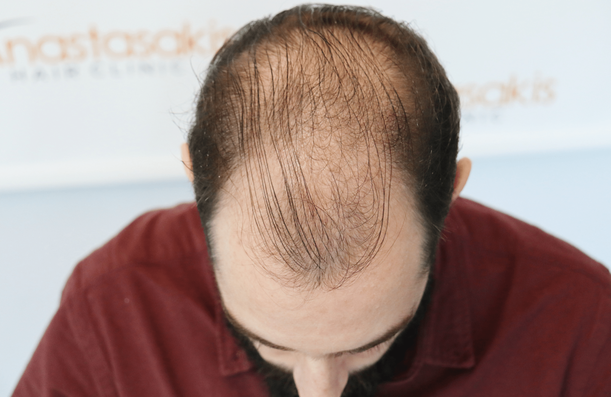 hair transplant result