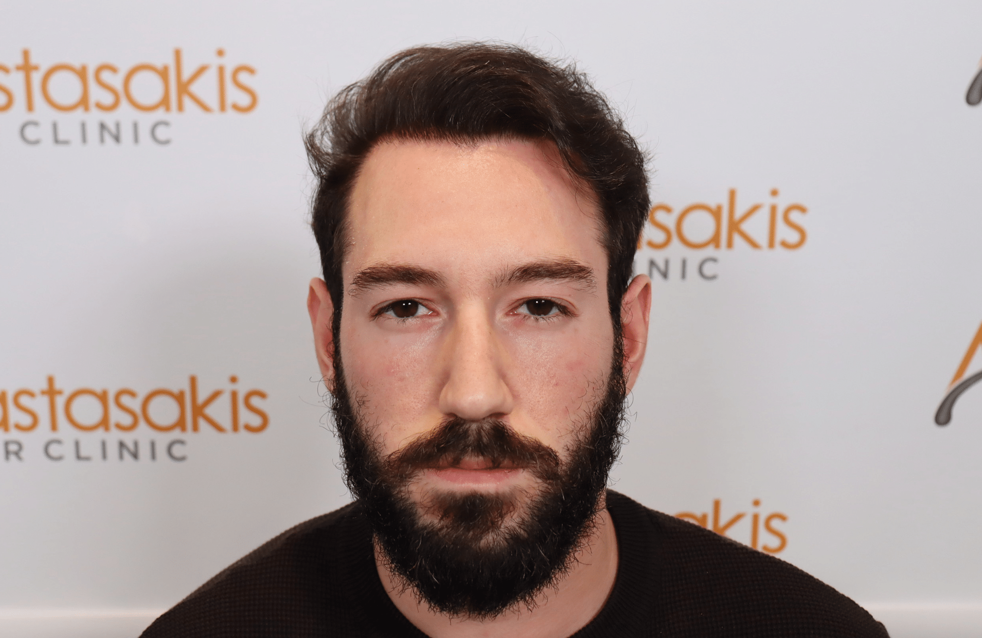 hair transplant result