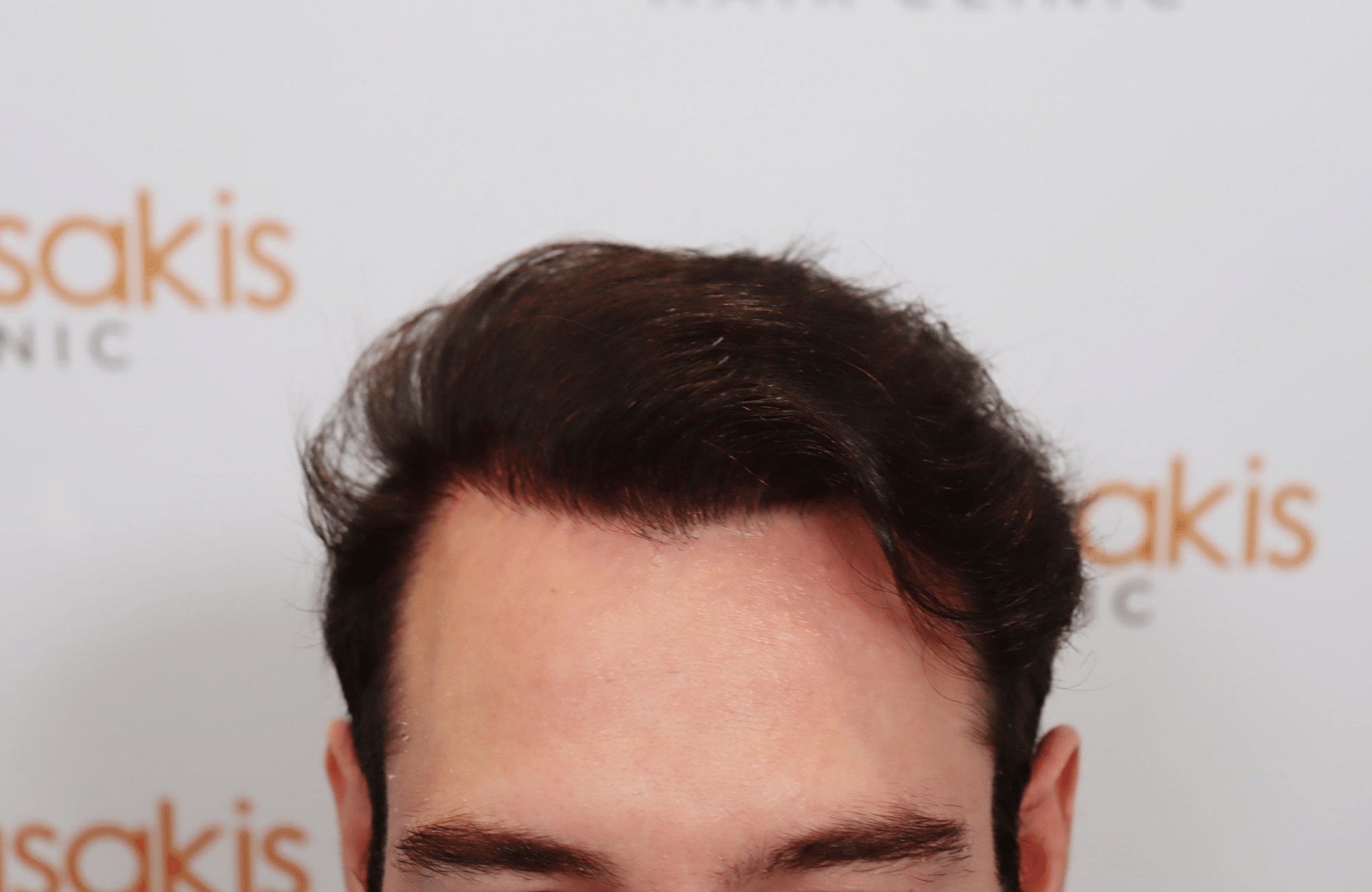 hair transplant result