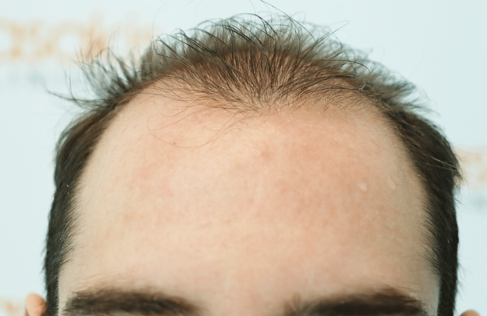 hair transplant result