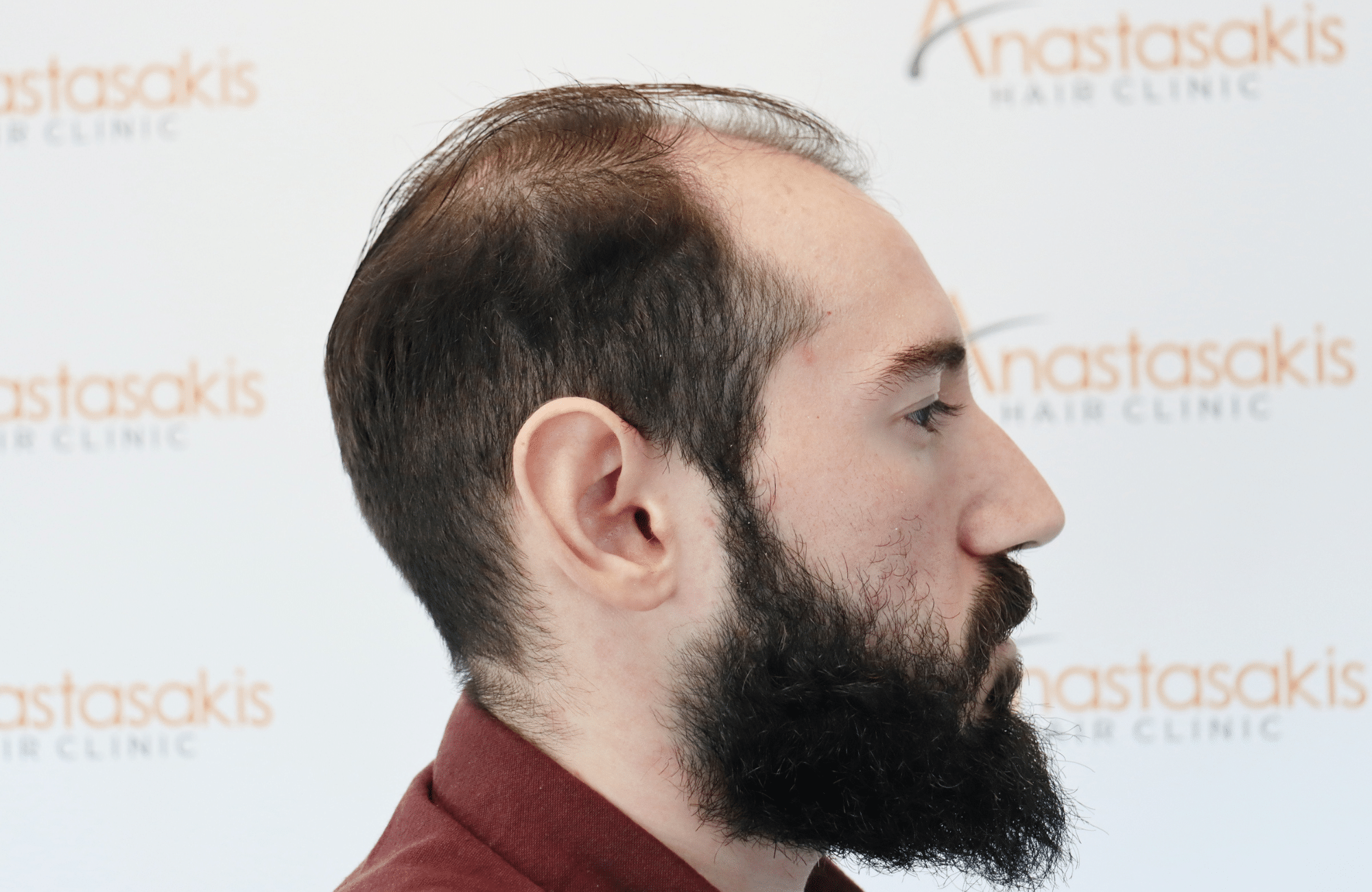 hair transplant result