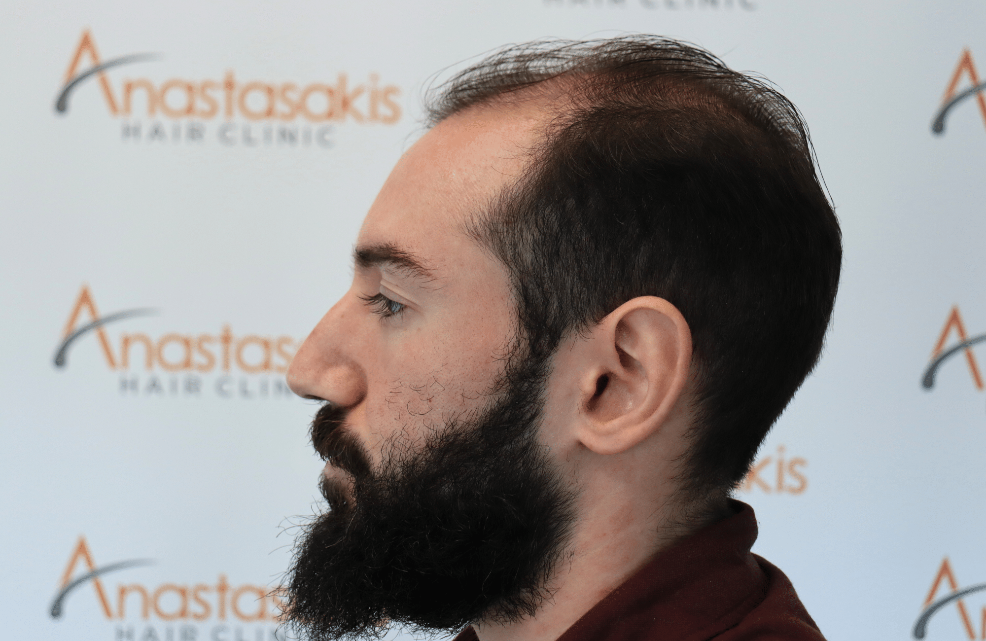 hair transplant result