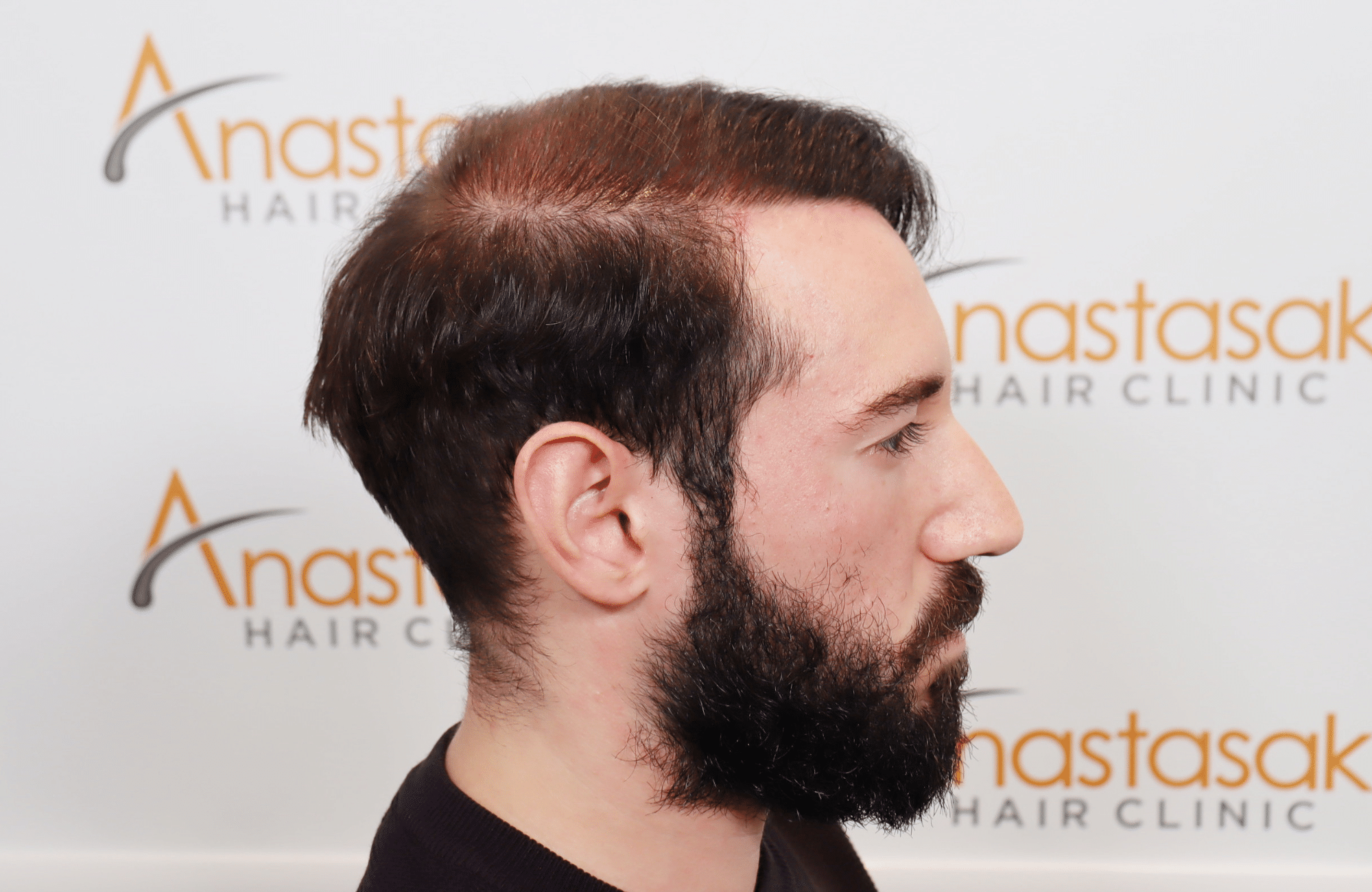 hair transplant result