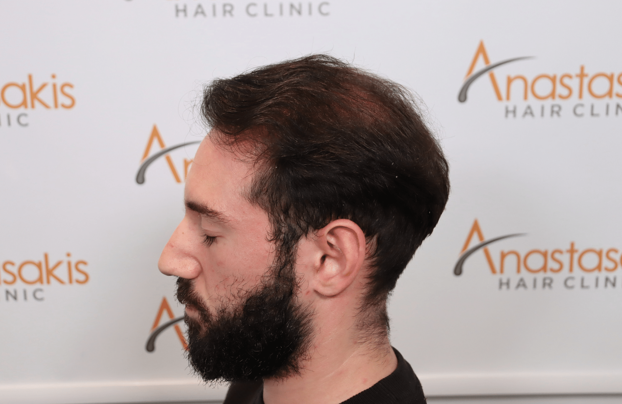 hair transplant result