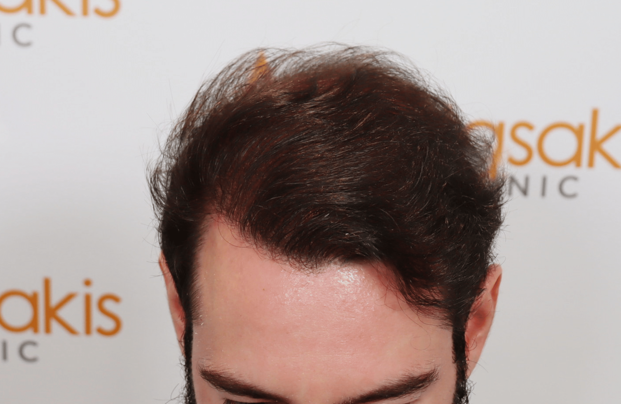 hair transplant result