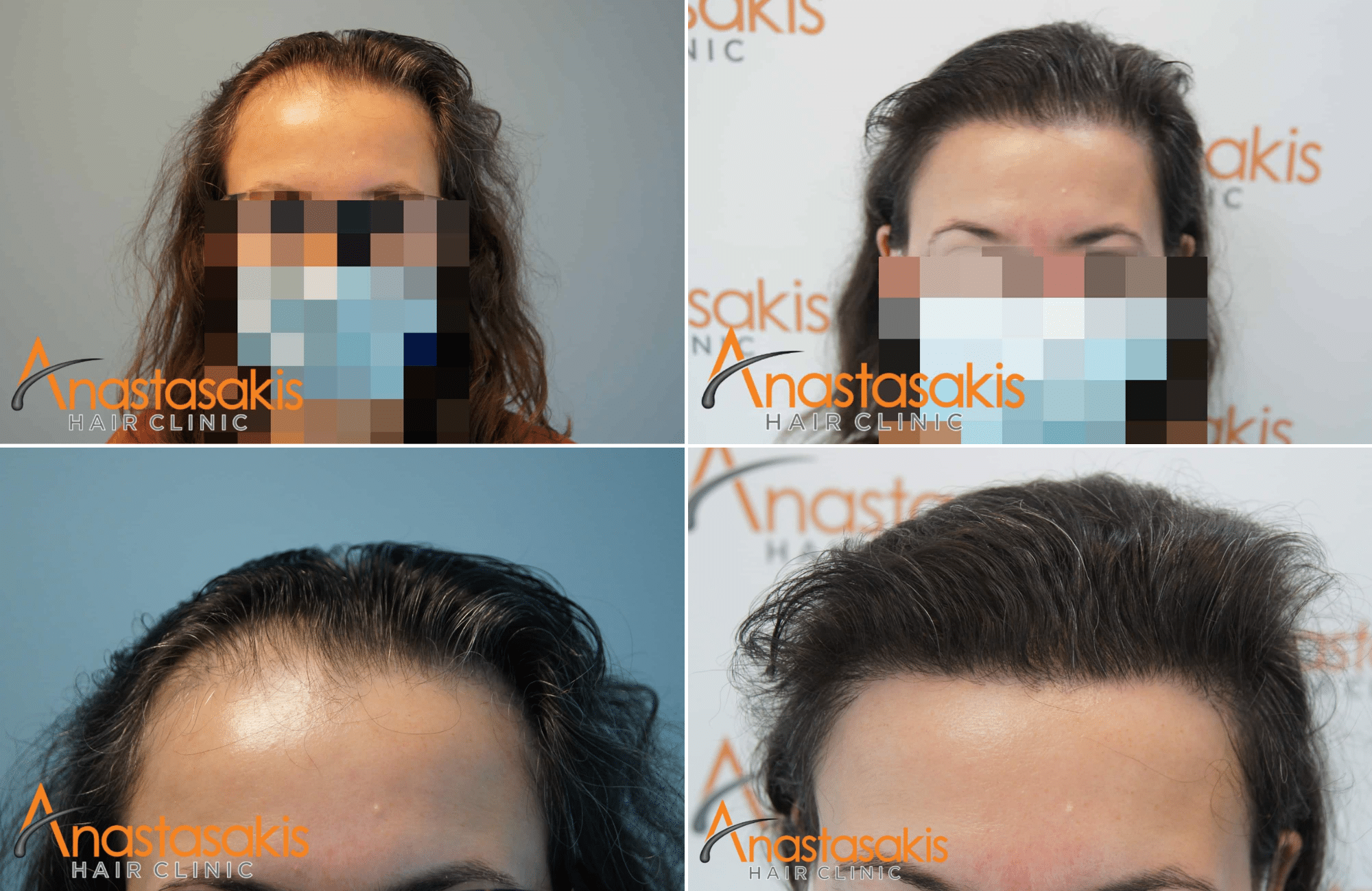 https://www.anastasakishairclinic.gr/portfolio/woman-hair-transplant-2600-fus-with-fut/