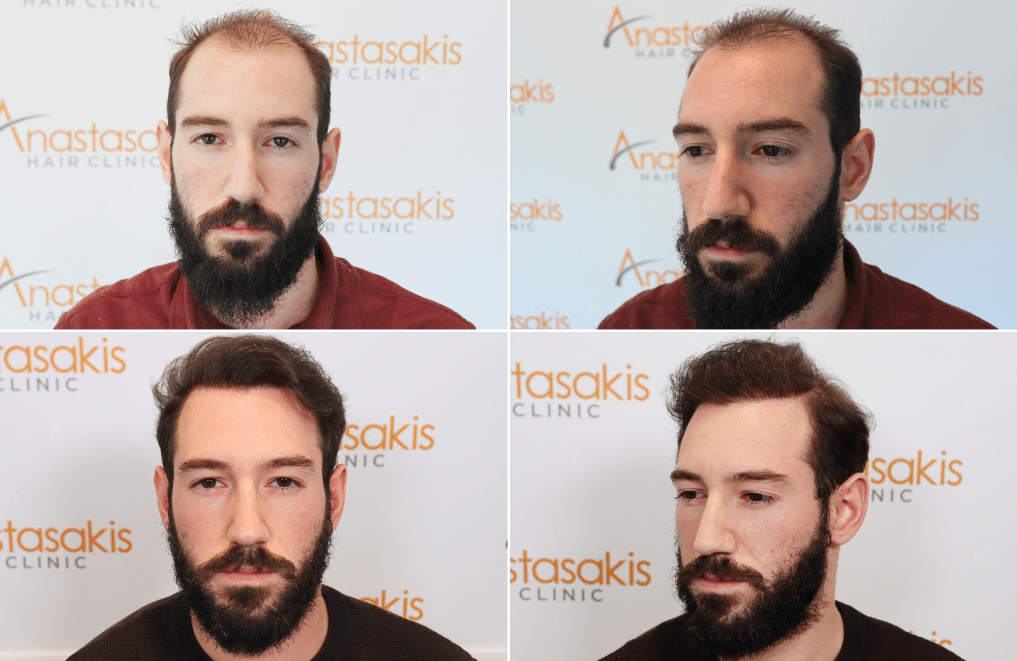 https://www.anastasakishairclinic.gr/portfolio/peristatiko-me-2500-fus-me-tin-texniki-fut/