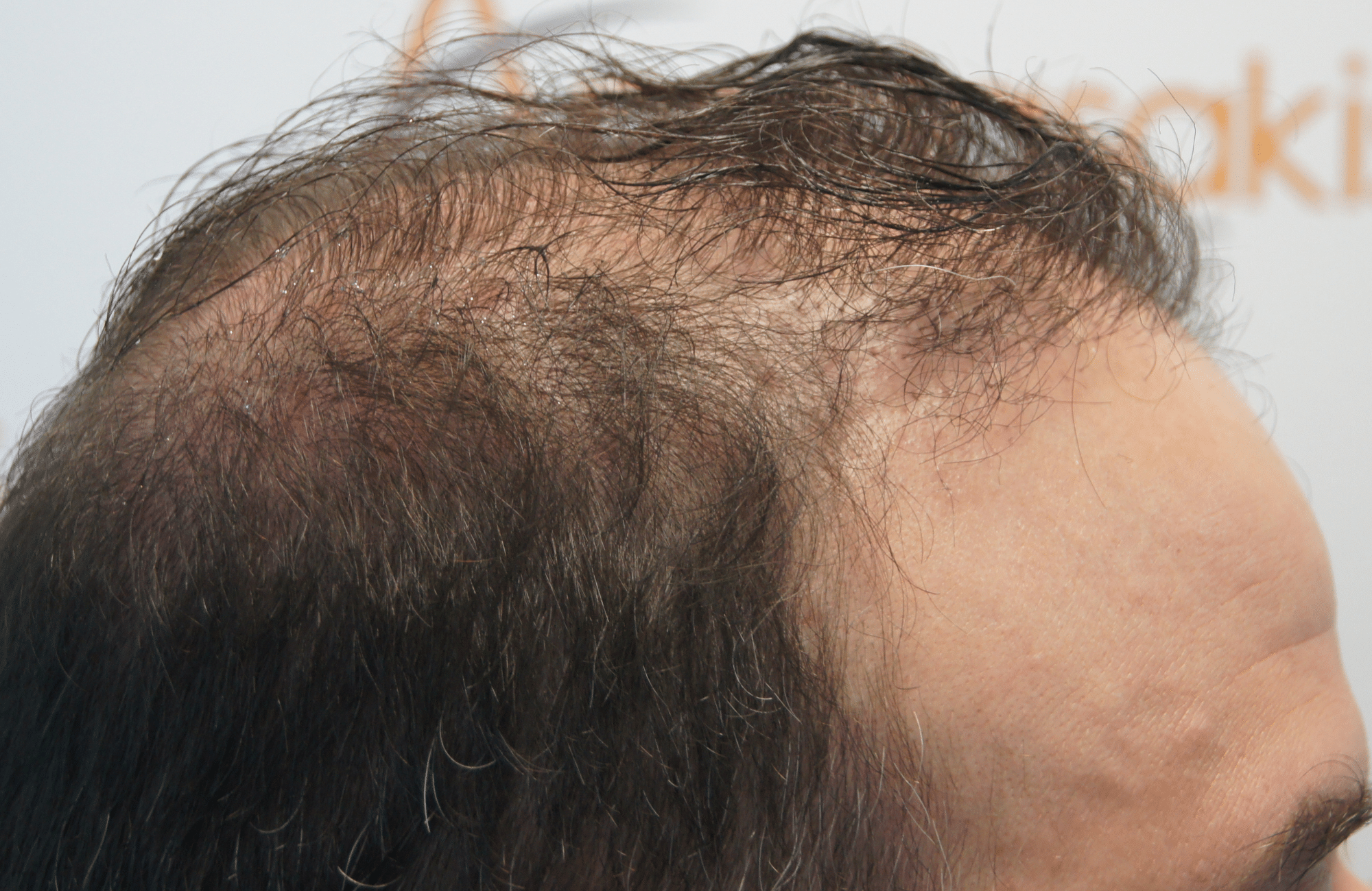 hair transplant result 5500 fus