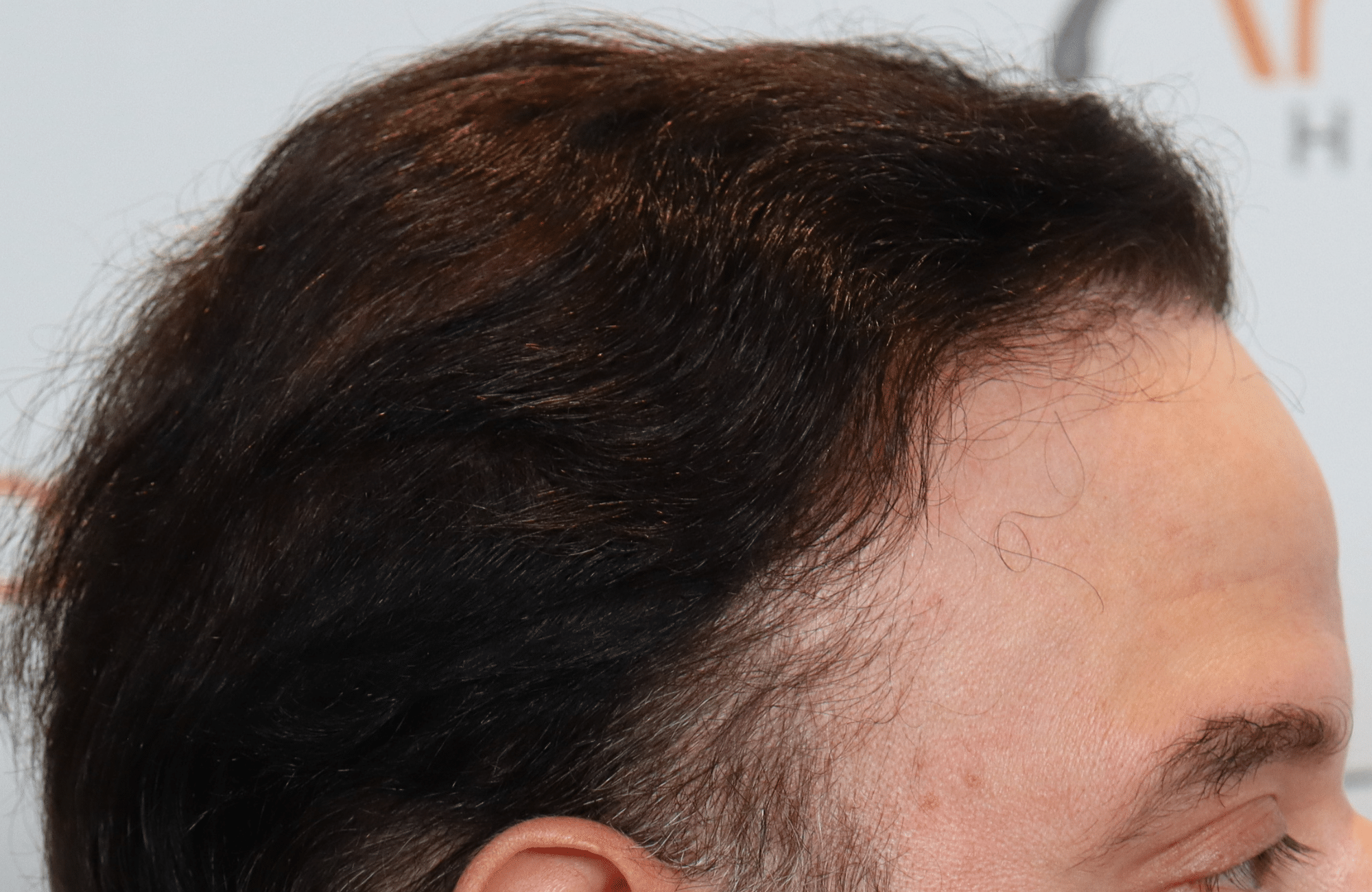 hair transplant result 5500 fus