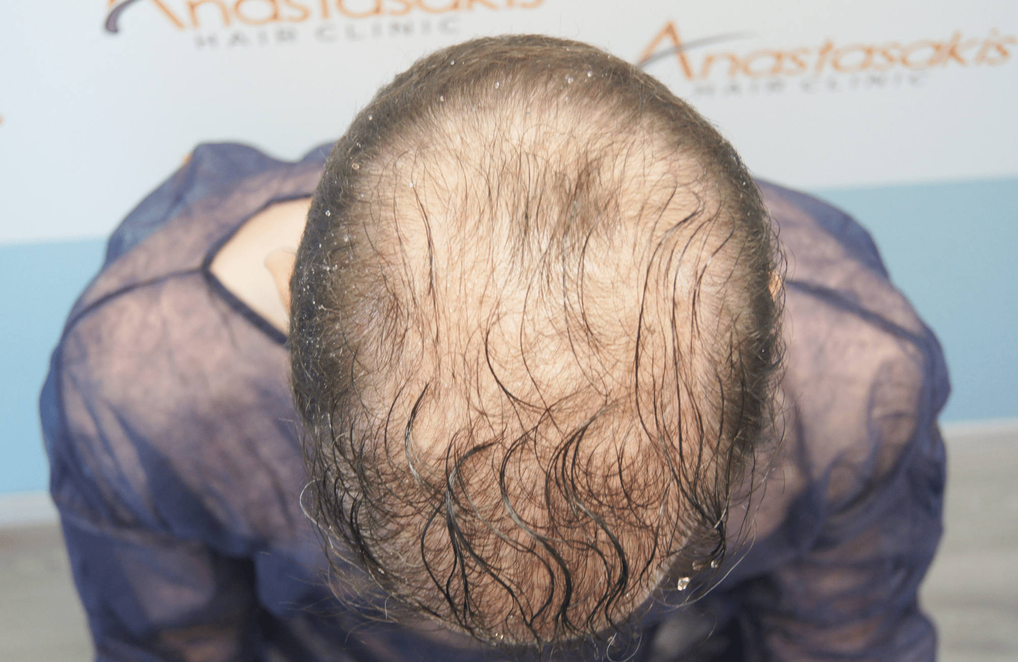 hair transplant result 5500 fus