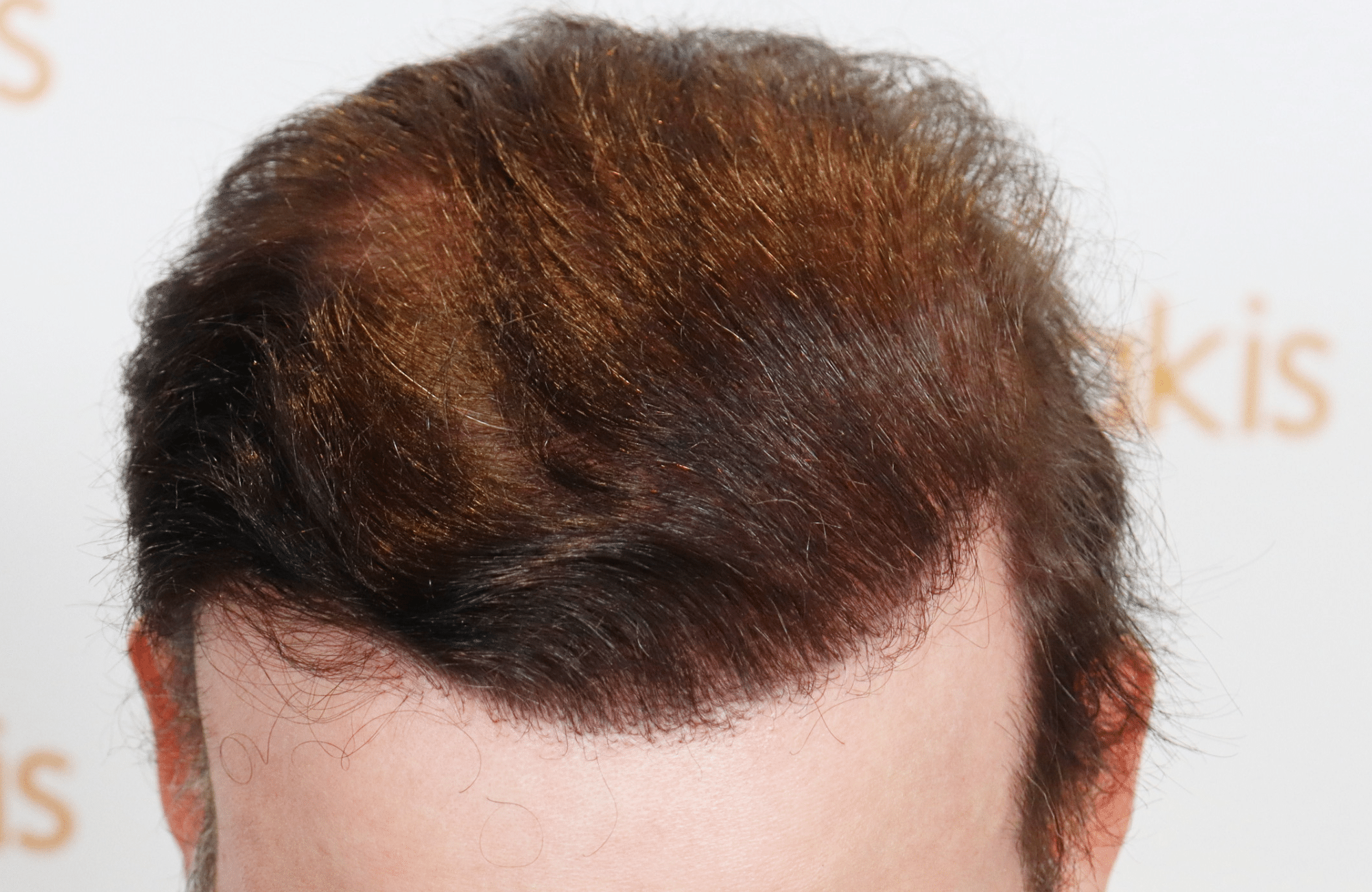 hair transplant result 5500 fus