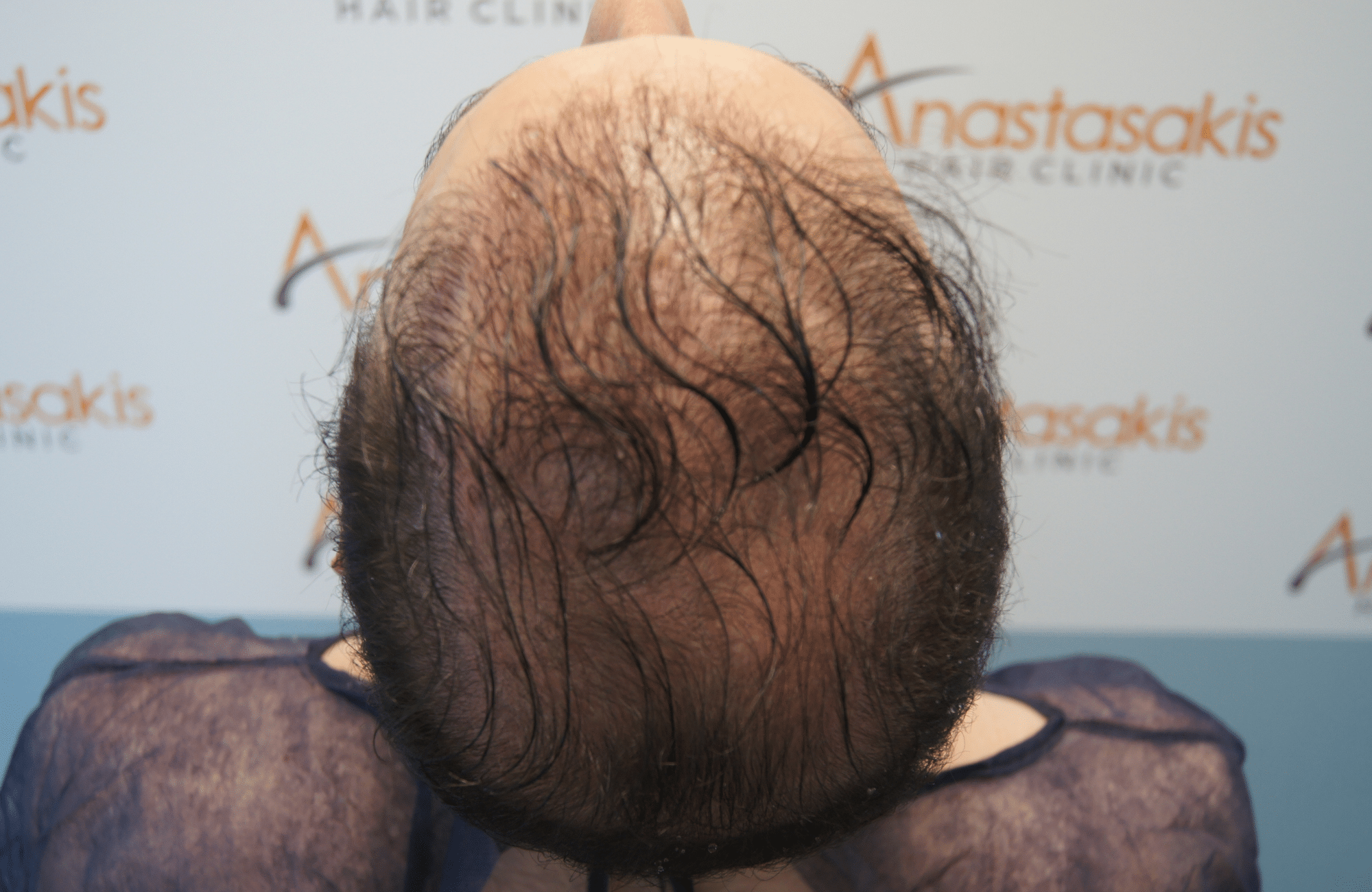 hair transplant result 5500 fus