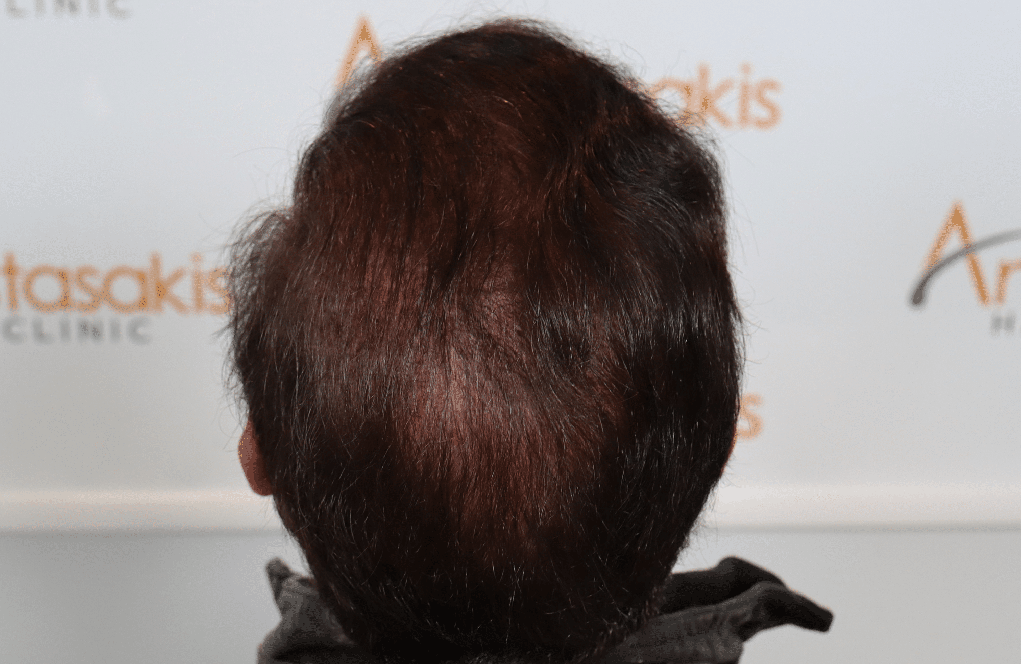 hair transplant result 5500 fus