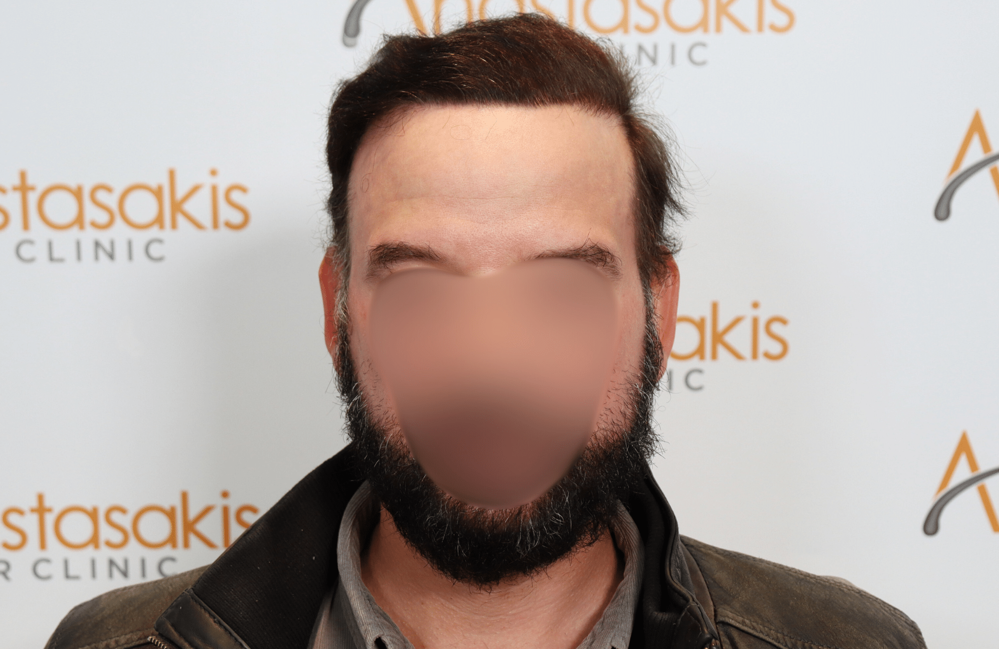 hair transplant result 5500 fus