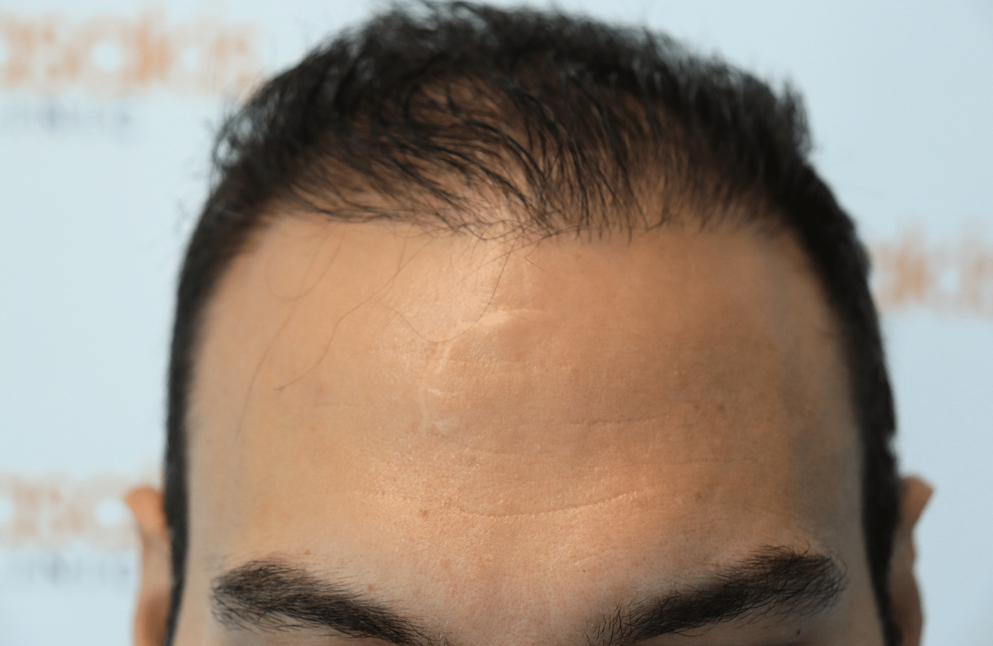 hair transplant