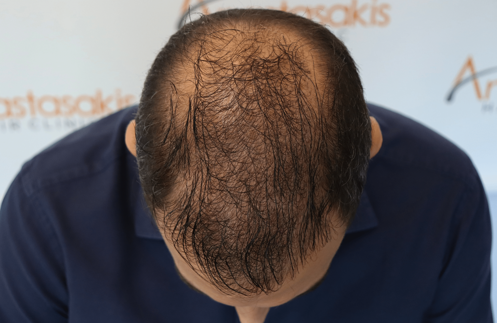 hair transplant