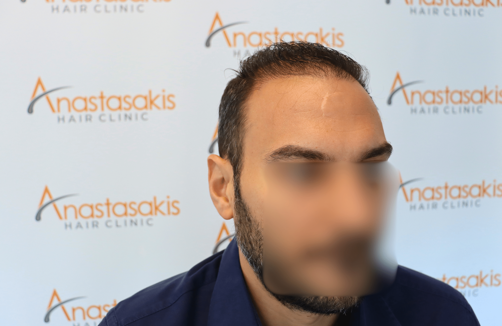 hair transplant
