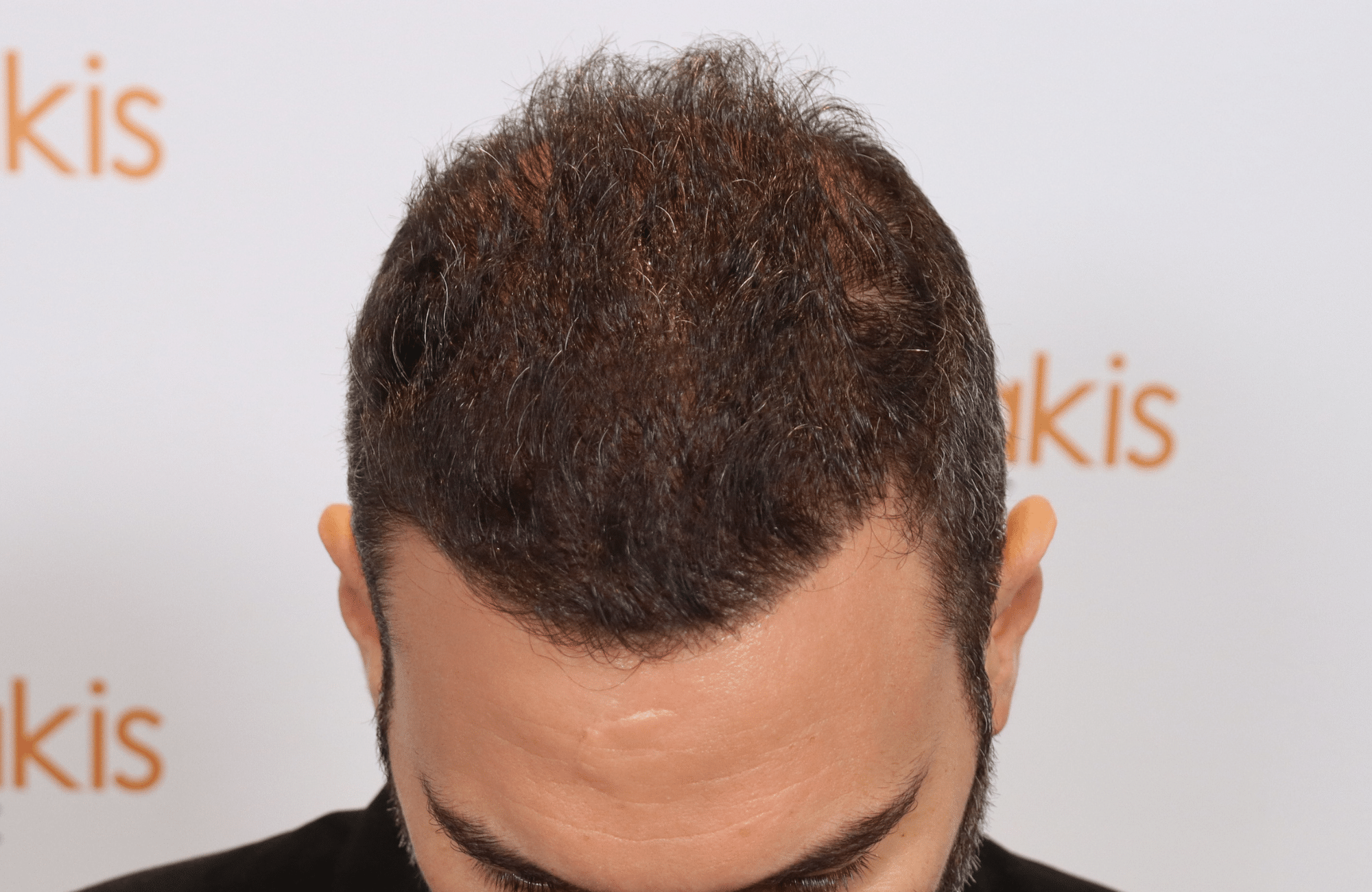 hair transplant