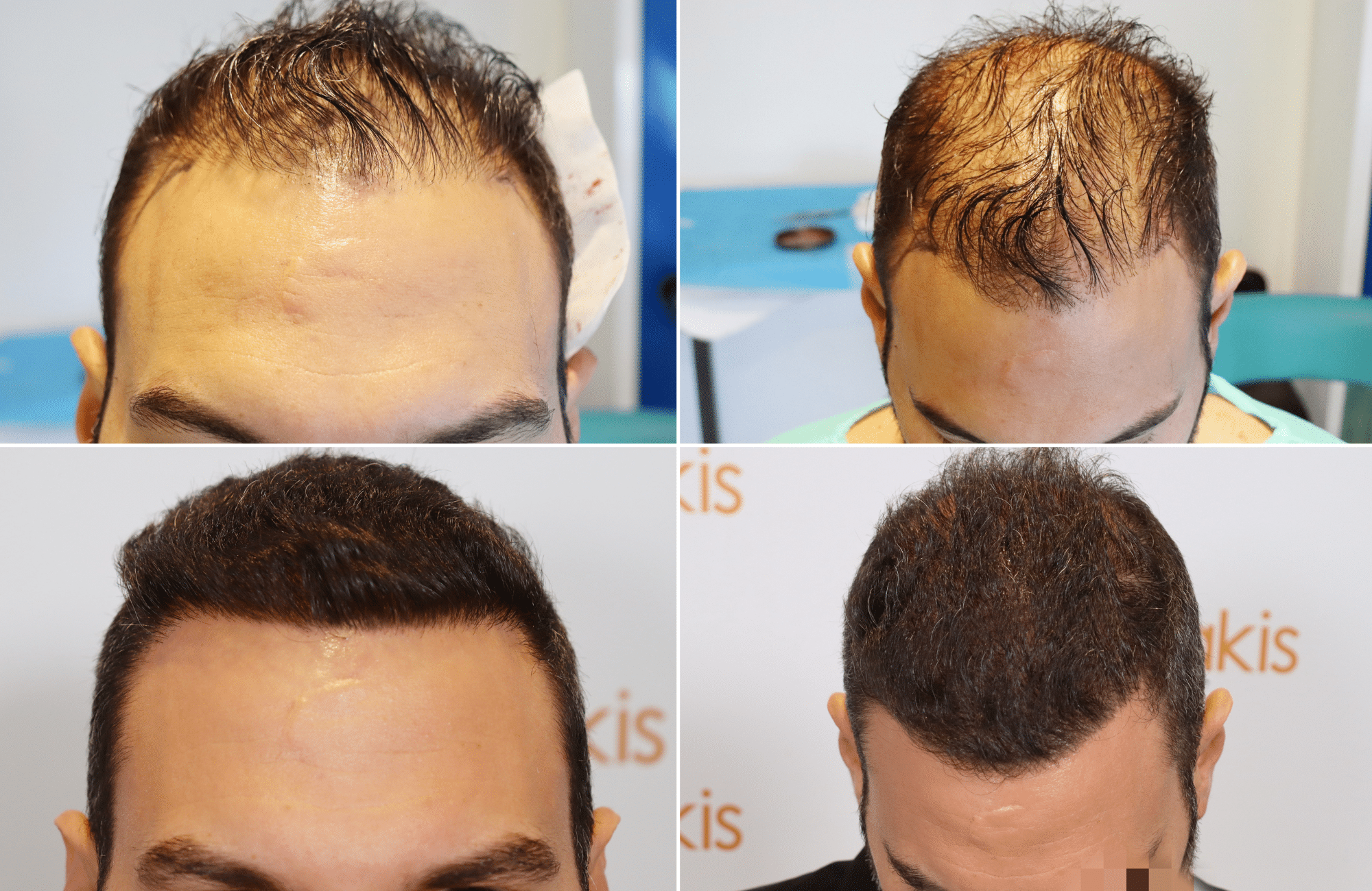 https://www.anastasakishairclinic.gr/portfolio/apotelesma-metamosxefsis-mallion-anastasakis-hair-clinic-242/