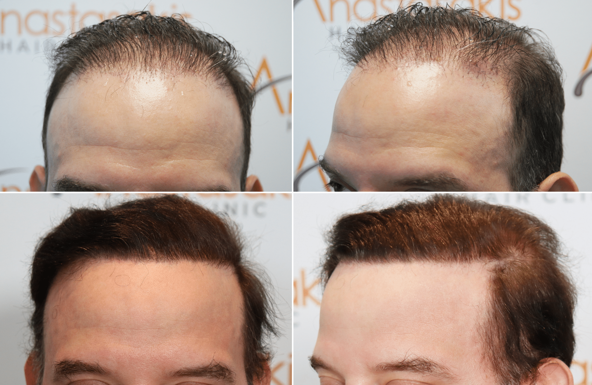 https://www.anastasakishairclinic.gr/portfolio/apotelesma-me-5500-fus-fue/