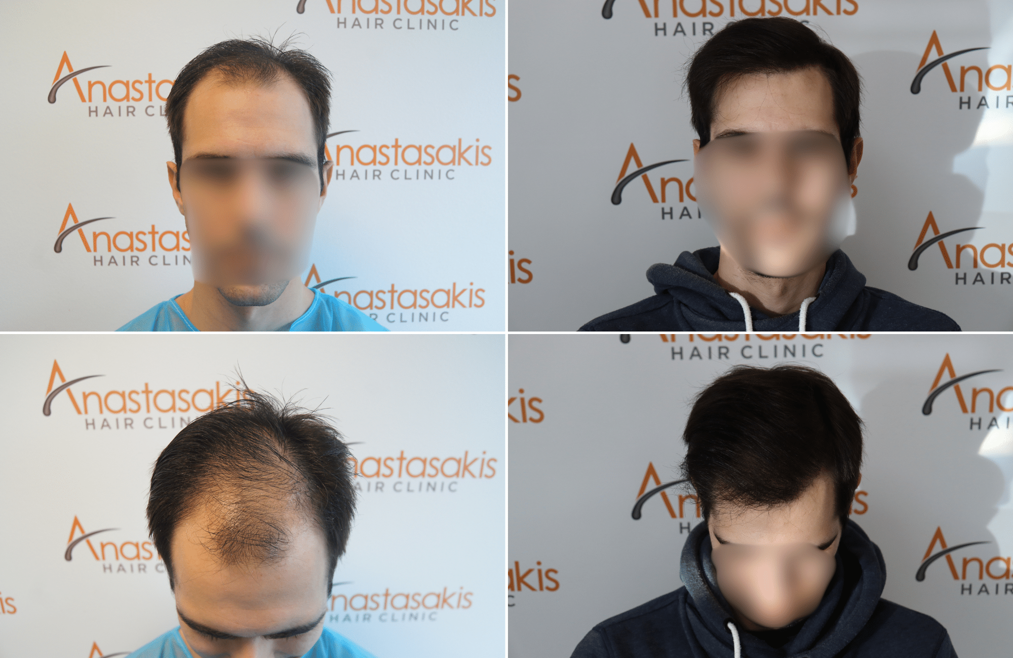 https://www.anastasakishairclinic.gr/portfolio/apotelesma-metamosxefsis-mallion-anastasakis-hair-clinic-192/