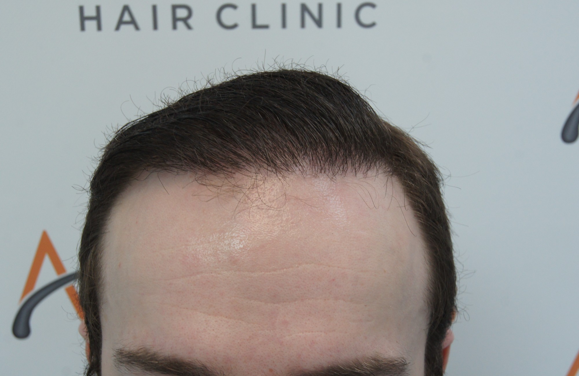 περιστατικο μεταμοσχευσης μαλλιων με FUT - 2307 τριχοθυλάκια - μετα - hairline