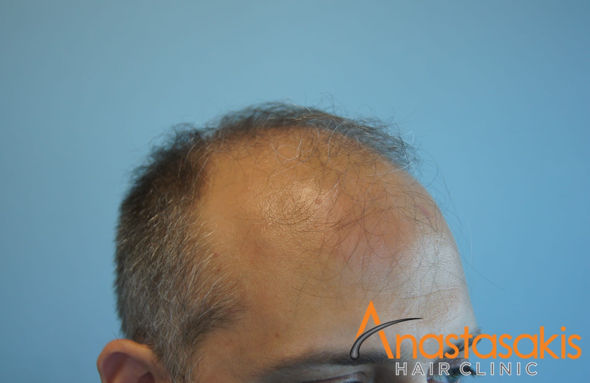 περιστατικο μεταμοσχευσης μαλλιων με FUT - 3500 τριχοθυλάκια - πριν - δεξια1