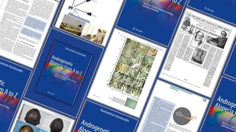 H Ανδρογενετική Αλωπεκία από το Α έως το Ω
