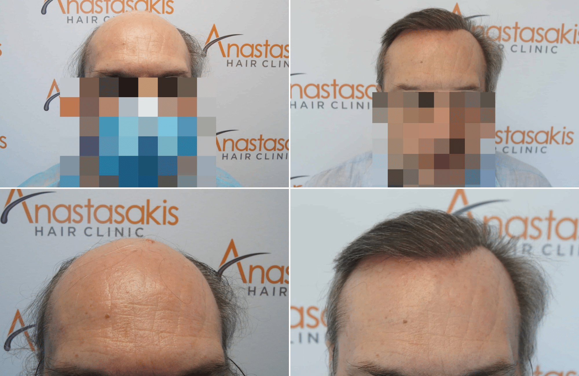 https://www.anastasakishairclinic.gr/portfolio/apotelesma-metamosxefsis-mallion-anastasakis-hair-clinic-336/