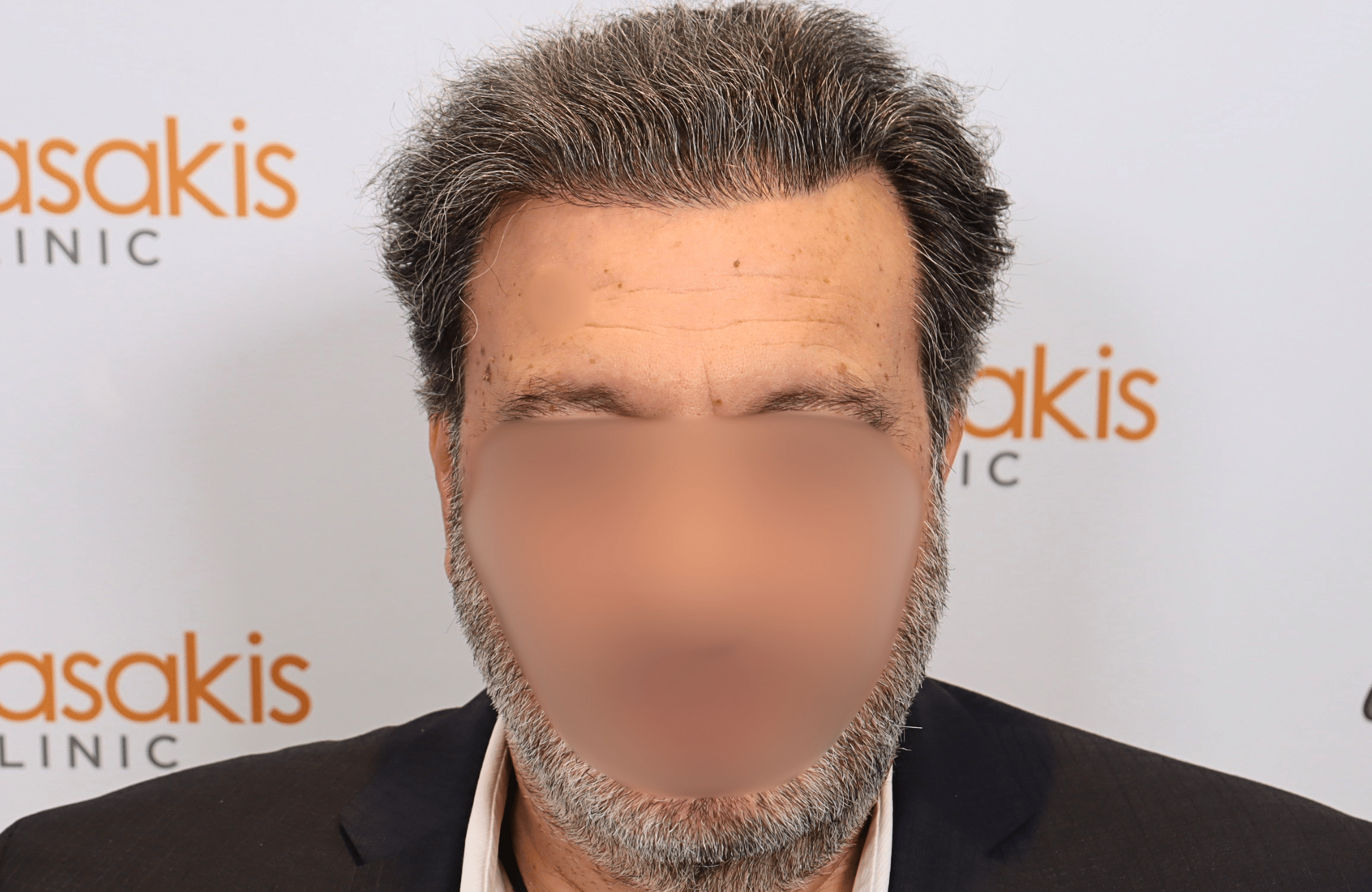 hair transplant result (1)