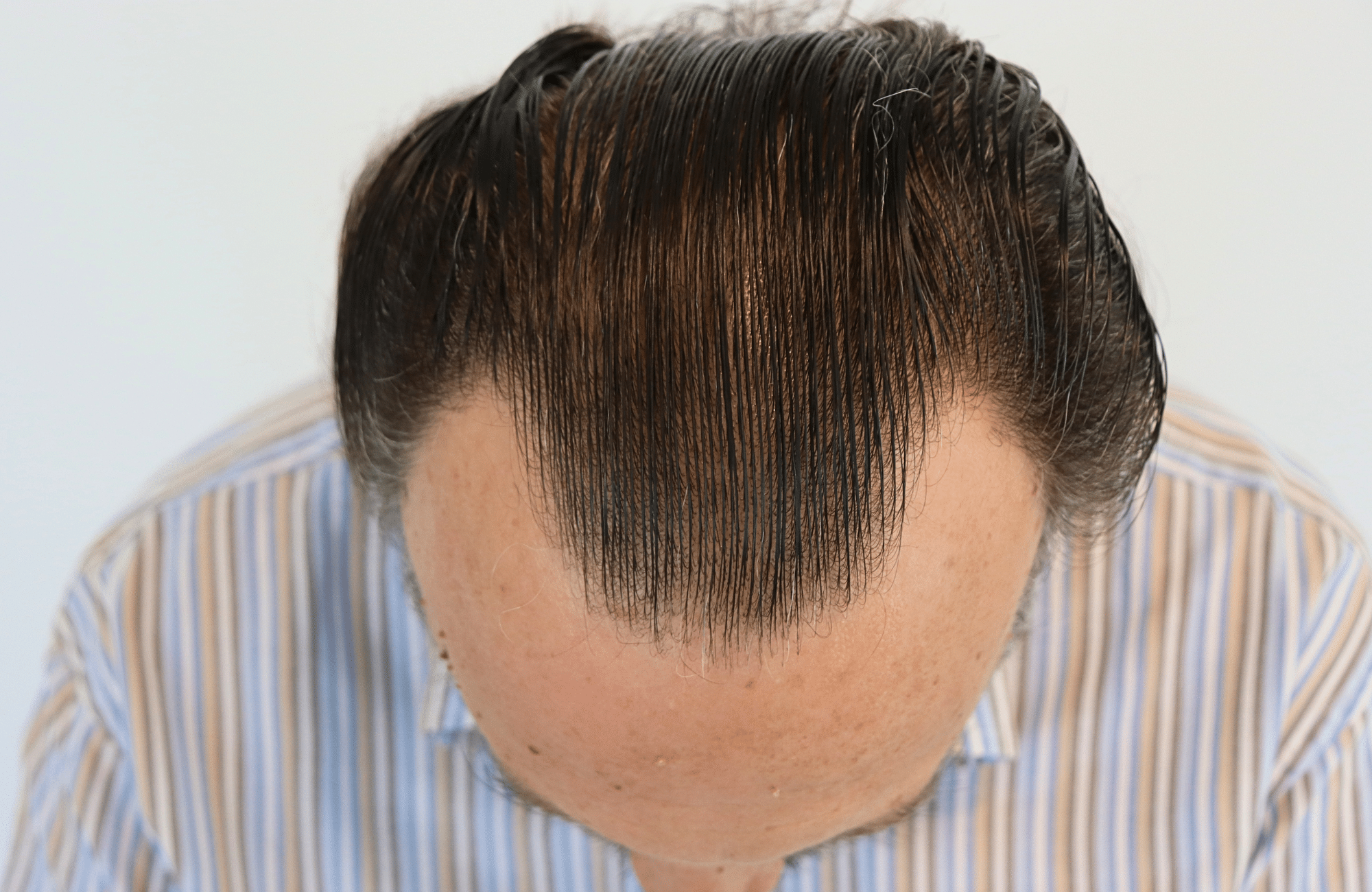 hair transplant result (10)