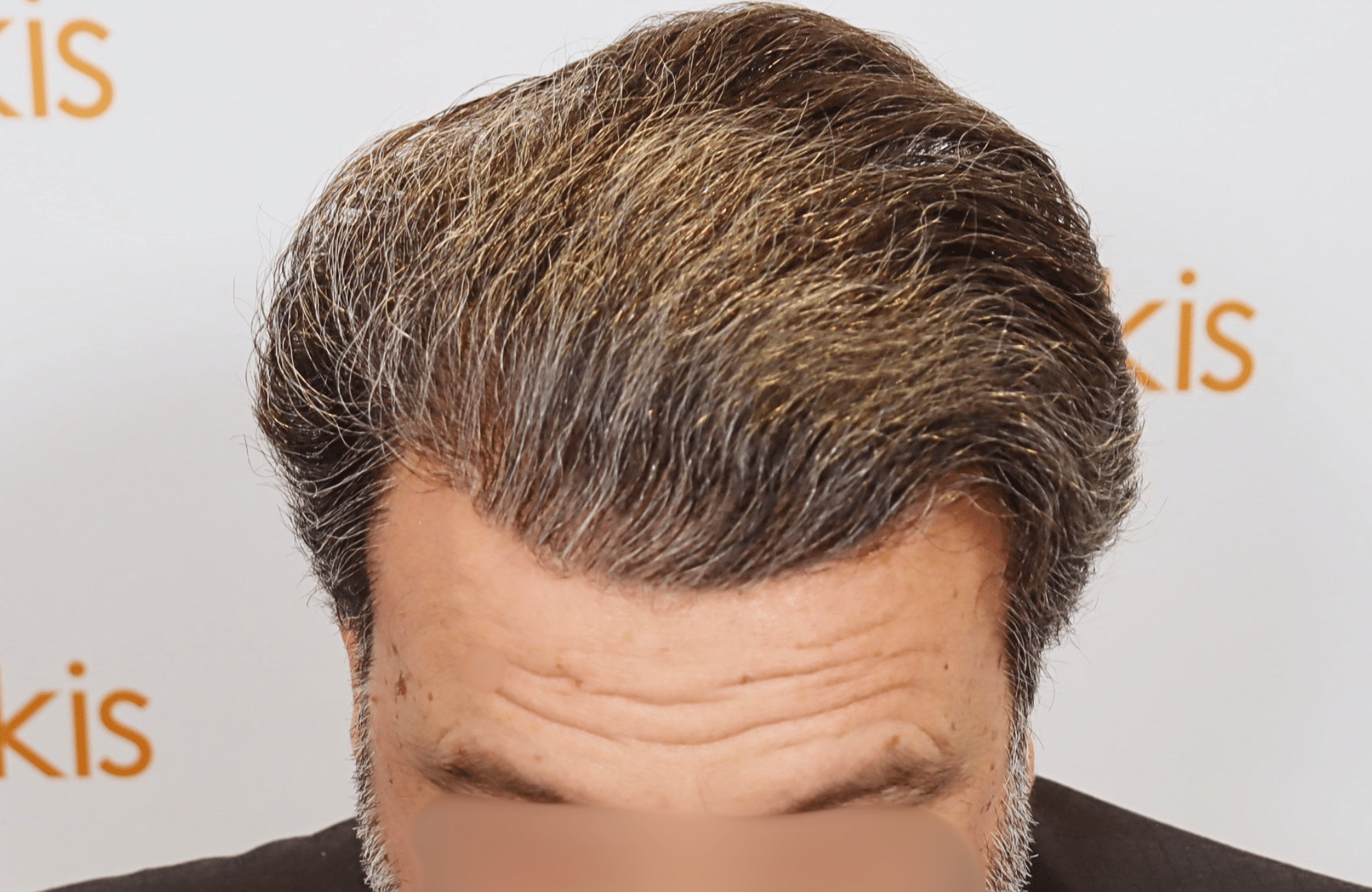 hair transplant result (11)