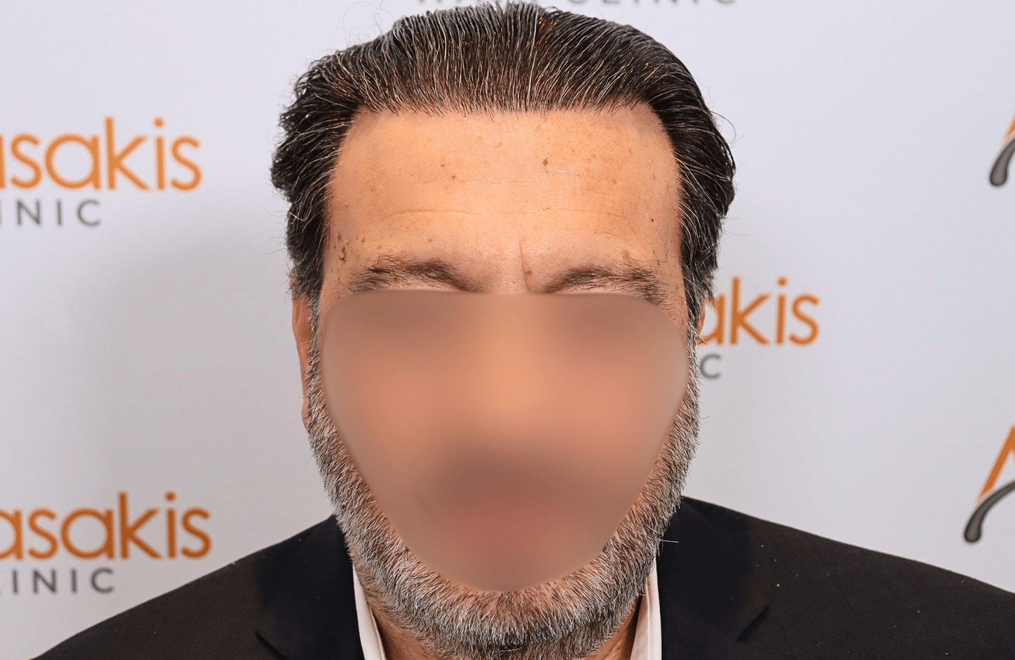 hair transplant result (12)
