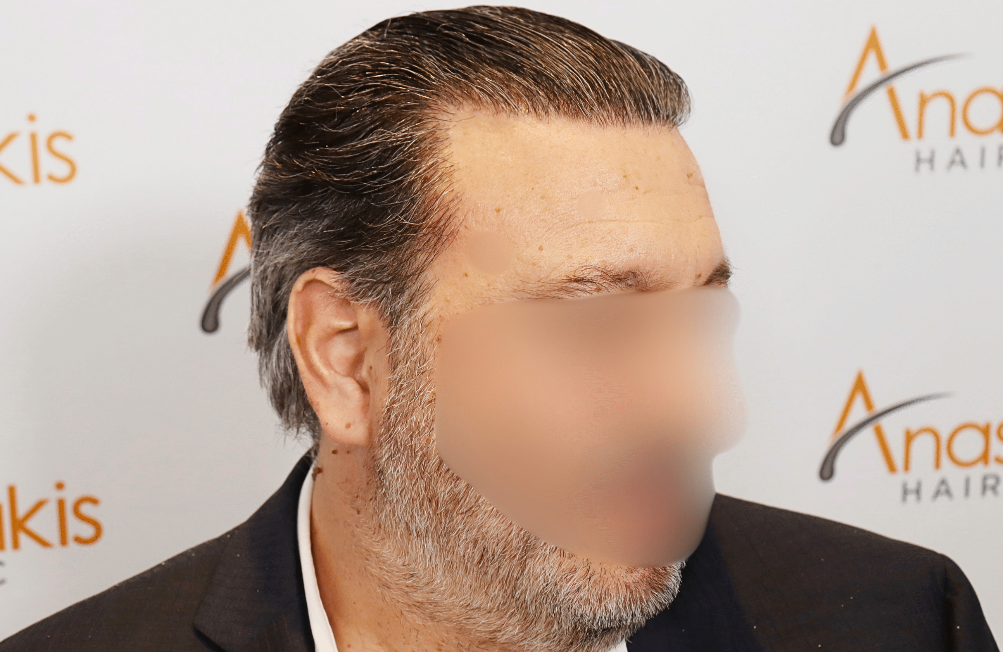 hair transplant result (13)