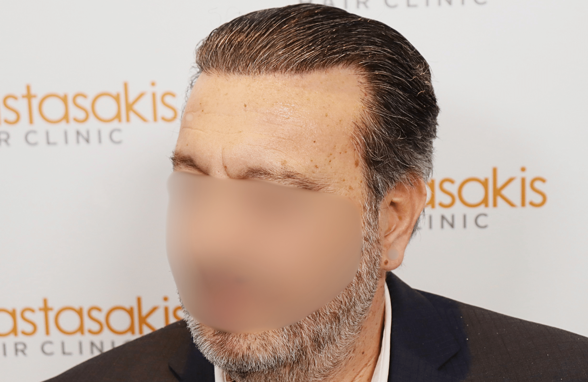 hair transplant result (14)