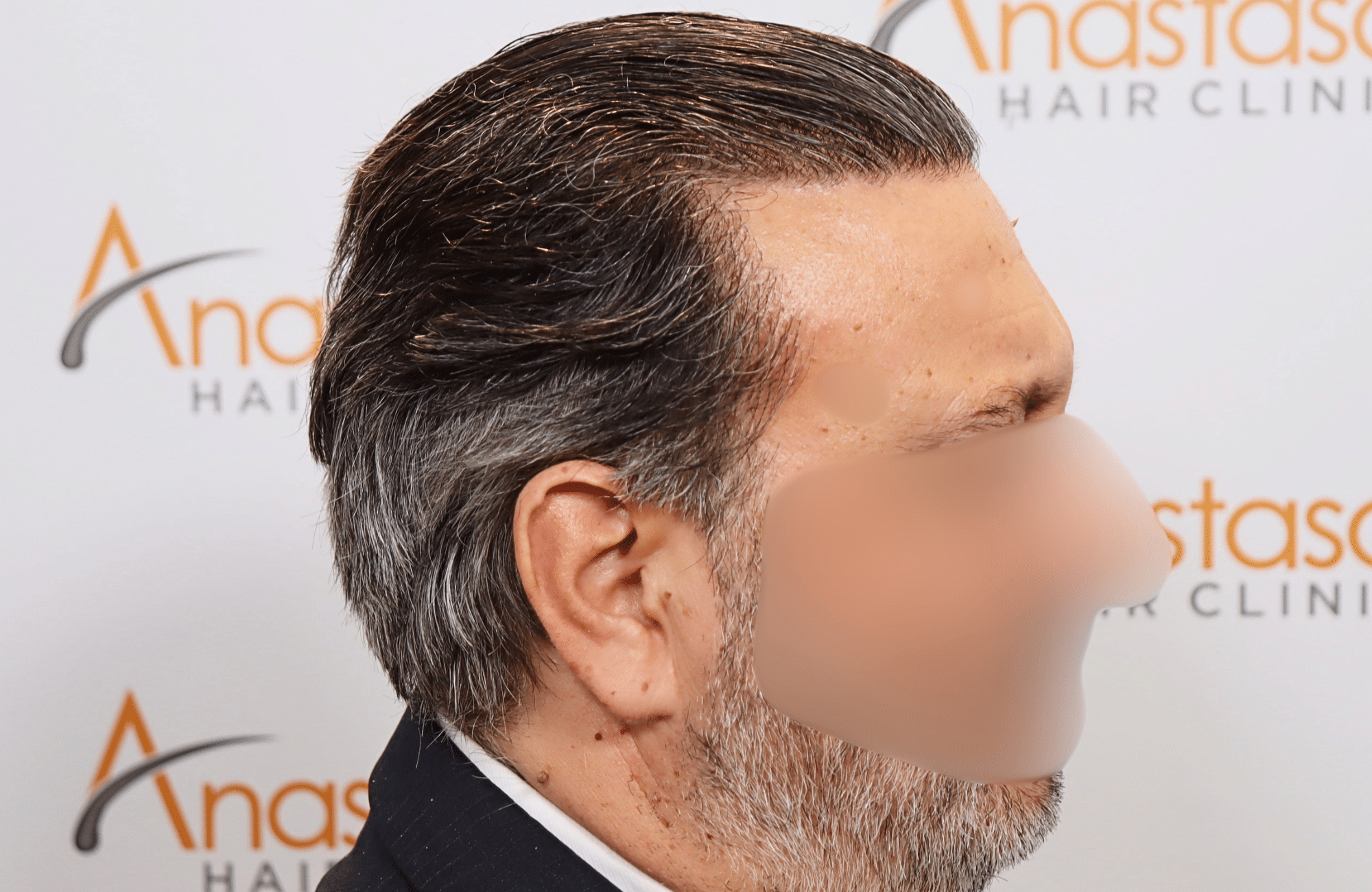 hair transplant result (15)