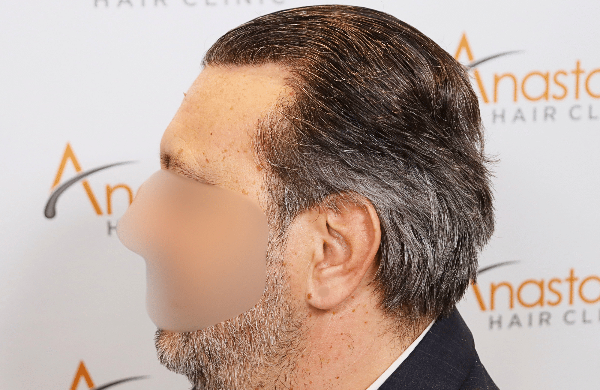 hair transplant result (16)