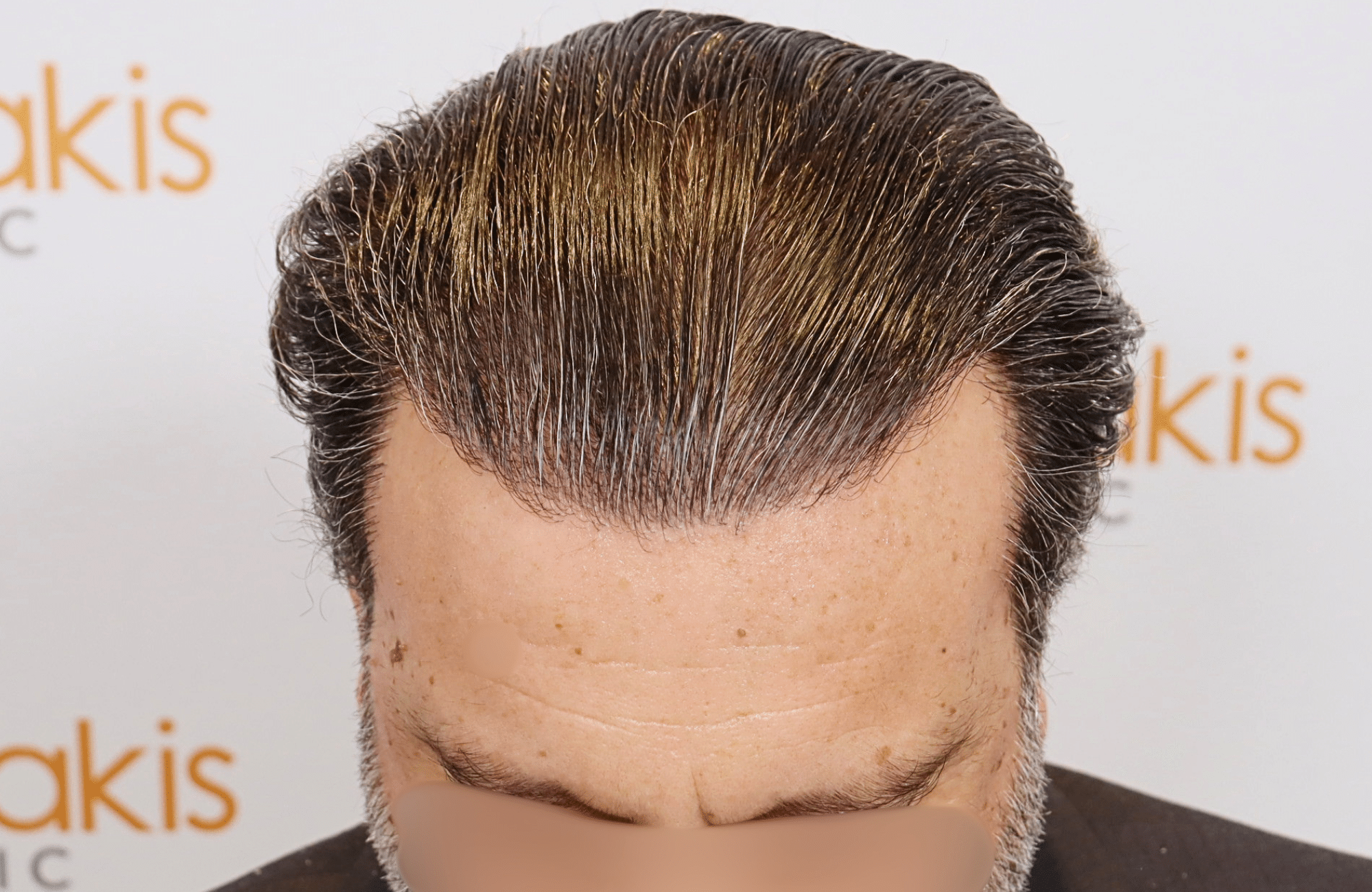 hair transplant result (17)