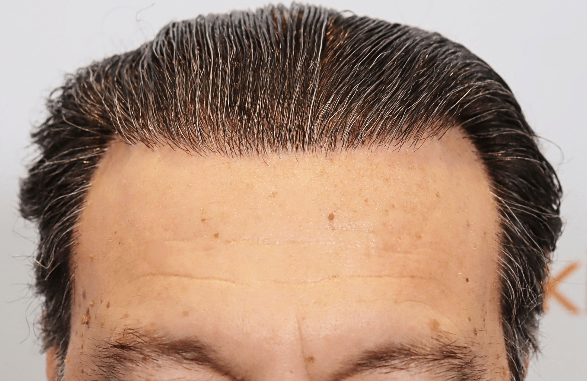 hair transplant result (18)