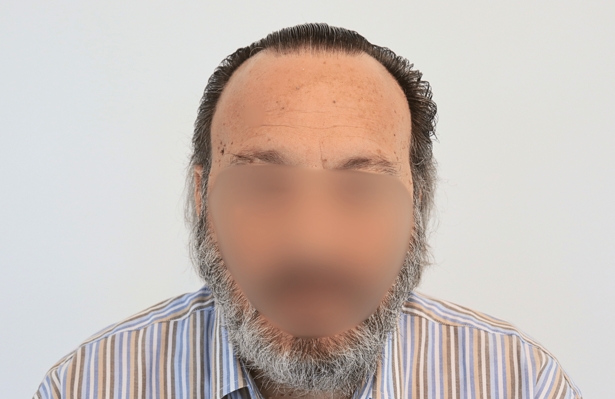 hair transplant result (19)